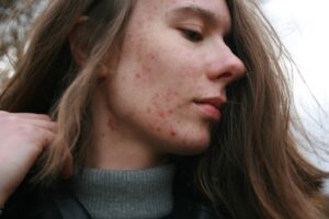 Was hilft gegen Pickelmale