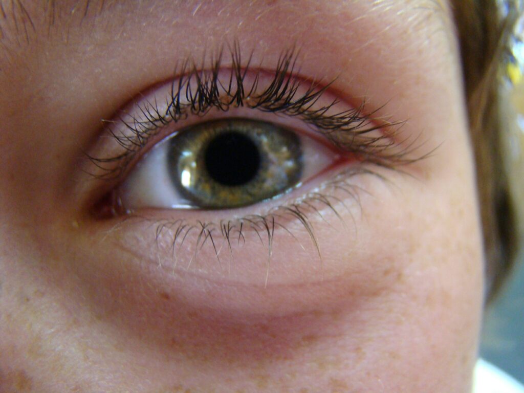 was hilft gegen ein geschwollenes auge