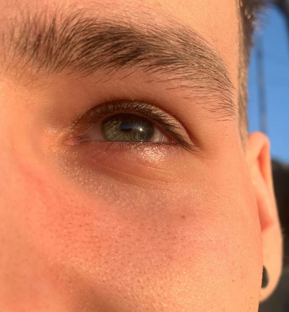 was hilft gegen sonnenallergie