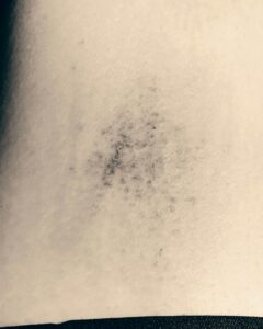 Was hilft gegen blaue Flecken